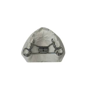 Disjoncteur sur bagues anatomiques côté -réalisations-orthodontie