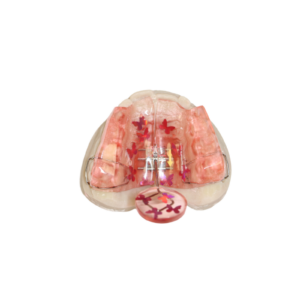 plaque-dexpansion-avec-surrelevation-molaires-réalisations-orthodontie